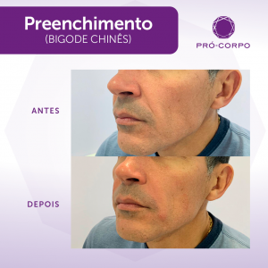 Preenchimento Bigode Chines Fotos  Antes e Depois
